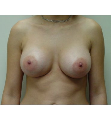 after breast implant